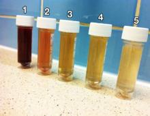 Orange-red urine.  Orange urine.  What determines the color of urine