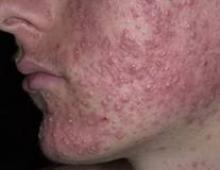 What does a pimple look like inside What does acne look like on the face