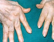 What to do if finger joints hurt?