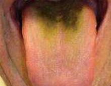 Causes of white and yellow plaque on the tongue