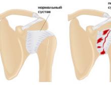 Periarthritis Periarthritis symptoms and treatment