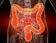 Benign and malignant tumor of the colon What are the signs of colon cancer