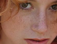 Dream interpretation of freckles on your face