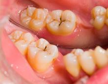 Dental caries: symptoms, stages, methods of treatment