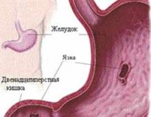 Acceptable and contraindicated foods for stomach ulcers